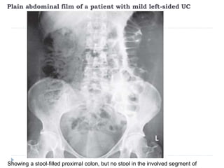 Plain abdominal film of a patient with mild left-sided UC
Showing a stool-filled proximal colon, but no stool in the involved segment of
 