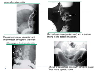 Extensive mucosal ulceration and
inflammation throughout the colon
Mucosal pseudopolyps (arrows) and a stricture
arising in the descending colon.
Shows a featureless colon with complete loss of
folds in the sigmoid colon.
 