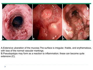 A.Extensive ulceration of the mucosa.The surface is irregular, friable, and erythematous,
with loss of the normal vascular markings.
B.Pseudopolyps may form as a reaction to inflammation; these can become quite
extensive (C).
 