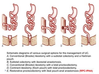 Schematic diagrams of various surgical options for the management of UC.
A, Conventional (Brooke) ileostomy with a subtotal colectomy and a Hartman
pouch.
B, Subtotal colectomy with ileorectal anastomosis.
C, Conventional (Brooke) ileostomy with a total proctocolectomy.
D, Continent ileostomy (Koch pouch) with total proctocolectomy.
E, Restorative proctocolectomy with ileal pouch-anal anastomosis (RPC-IPAA)
 
