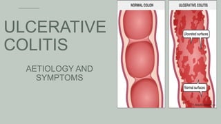 ULCERATIVE
COLITIS
AETIOLOGY AND
SYMPTOMS
 