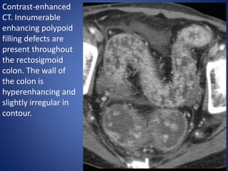 Colon Defect Ulcerative colitis explanation, management and therapy | PPTX