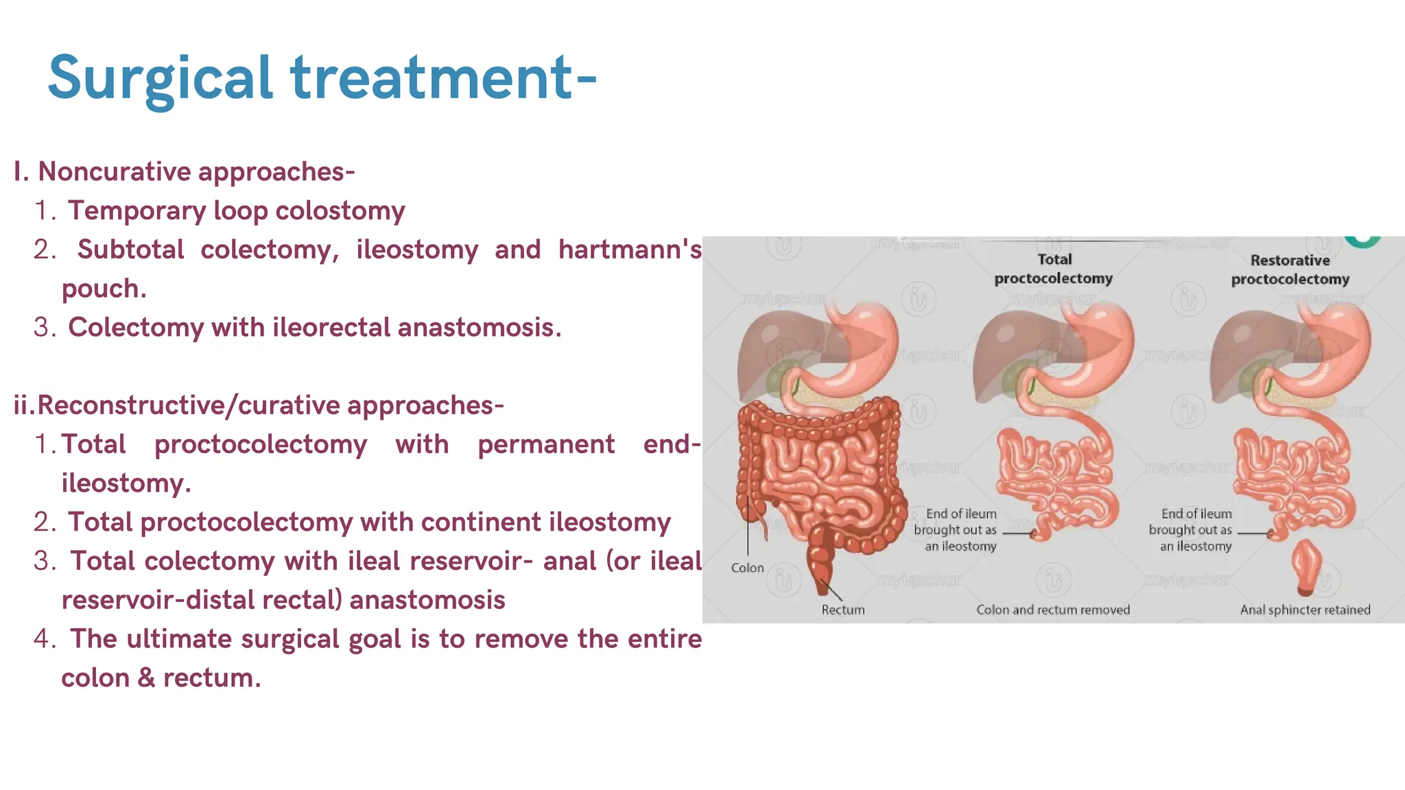 Surgical treatment-
I. Noncurative approaches-
Temporary loop colostomy
1.
Subtotal colectomy, ileostomy and hartmann's
pouch.
2.
Colectomy with ileorectal anastomosis.
3.
ii.Reconstructive/curative approaches-
Total proctocolectomy with permanent end-
ileostomy.
1.
Total proctocolectomy with continent ileostomy
2.
Total colectomy with ileal reservoir- anal (or ileal
reservoir-distal rectal) anastomosis
3.
The ultimate surgical goal is to remove the entire
colon & rectum.
4.
 