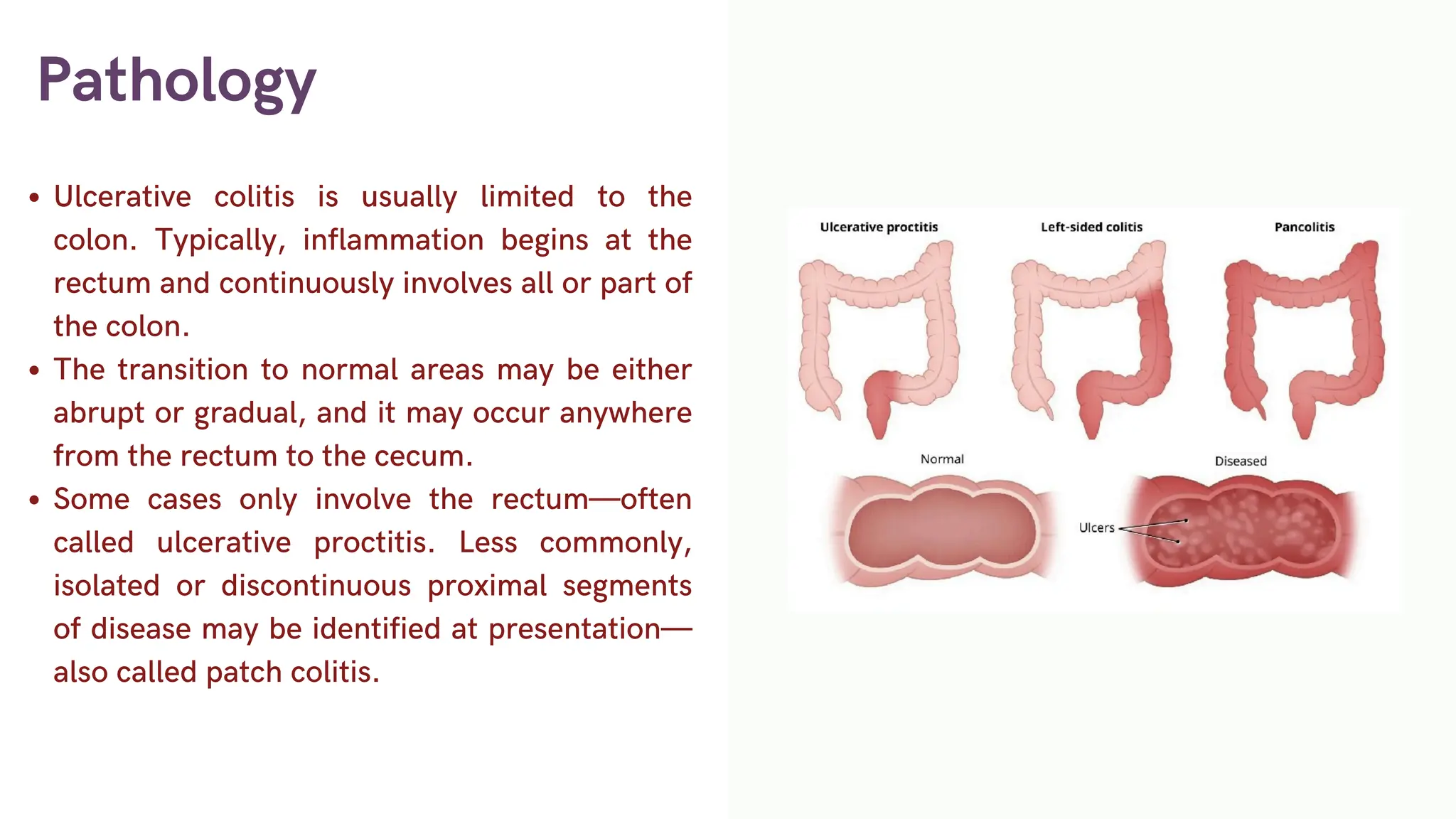 Pathology
Ulcerative colitis is usually limited to the
colon. Typically, inflammation begins at the
rectum and continuously involves all or part of
the colon.
The transition to normal areas may be either
abrupt or gradual, and it may occur anywhere
from the rectum to the cecum.
Some cases only involve the rectum—often
called ulcerative proctitis. Less commonly,
isolated or discontinuous proximal segments
of disease may be identified at presentation—
also called patch colitis.
 