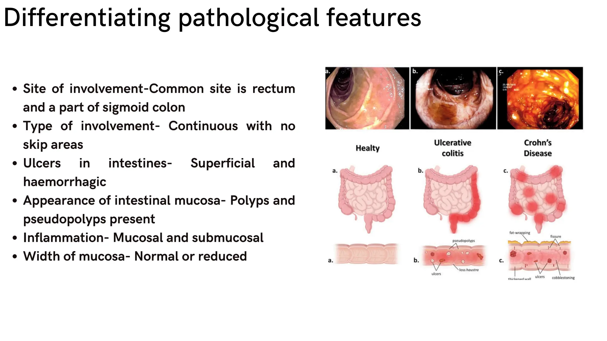 Site of involvement-Common site is rectum
and a part of sigmoid colon
Type of involvement- Continuous with no
skip areas
Ulcers in intestines- Superficial and
haemorrhagic
Appearance of intestinal mucosa- Polyps and
pseudopolyps present
Inflammation- Mucosal and submucosal
Width of mucosa- Normal or reduced
Differentiating pathological features
 