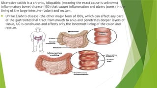 Ulcerative Colitis Gi Comprehensive Overview of Ulcerative Colitis: Pathophysiology, Symptoms ...