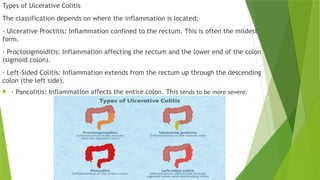 Comprehensive Overview of Ulcerative Colitis: Pathophysiology, Symptoms ...
