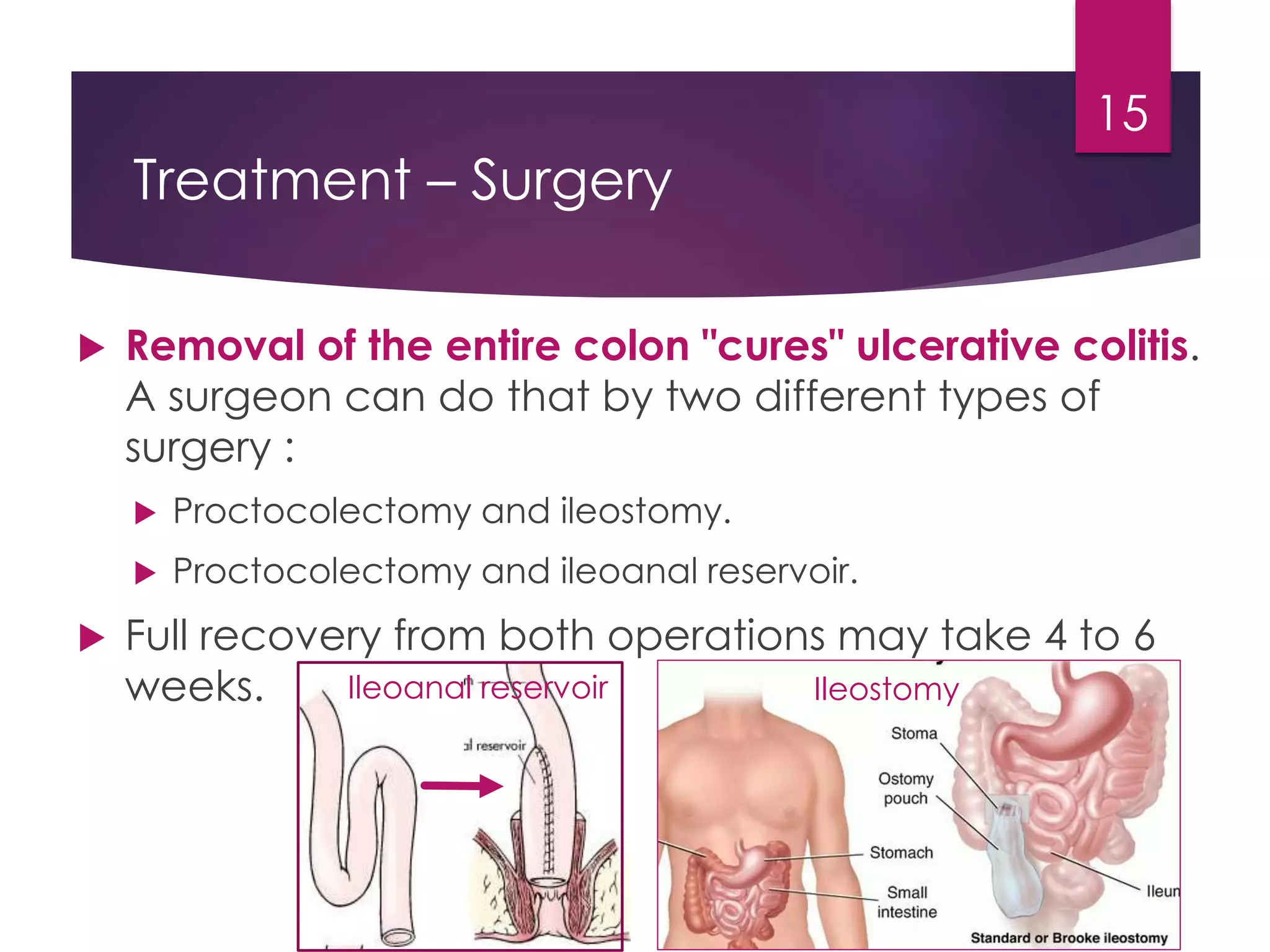 inflammatory bowel disease (Ulcerative colitis , crohn's disease) | PPTX