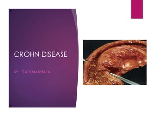 CROHN DISEASE
BY : SADI NAKHALA
 
