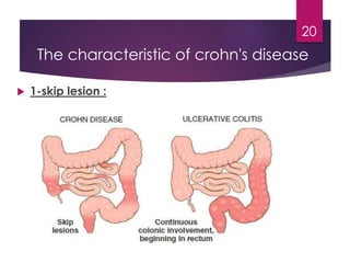  1-skip lesion :
20
The characteristic of crohn's disease
 