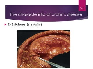 The characteristic of crohn's disease
 2- Strictures (stenosis )
21
 