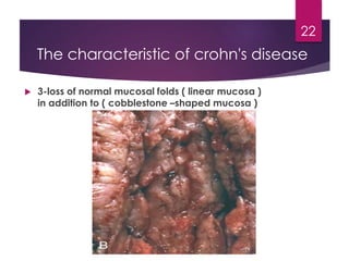  3-loss of normal mucosal folds ( linear mucosa )
in addition to ( cobblestone –shaped mucosa )
22
The characteristic of crohn's disease
 