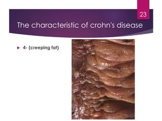  4- (creeping fat)
23
The characteristic of crohn's disease
 