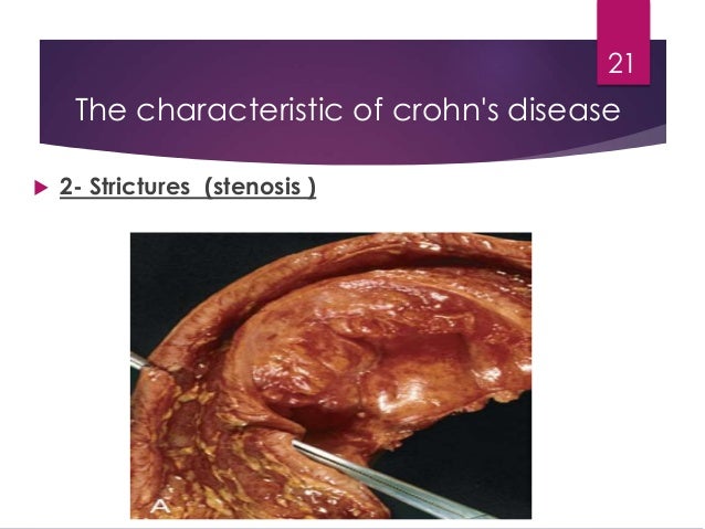 the characteristics of crohns illness an inflammatory bowel disease Inflammatory bowel disease - crohns conditions collectively known as inflammatory bowel disease pre-illness weight and/or recent weight changes is. the characteristics of crohns illness an inflammatory bowel disease Inflammatory bowel disease - crohns conditions collectively known as inflammatory bowel disease pre-illness weight and/or recent weight changes is.