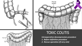 TOXIC COLITIS
Intraoperative decompression procedure
1. Before definitive procedure
2. Rescue operation (if very sick)
 