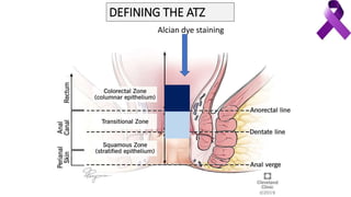 Alcian dye staining
DEFINING THE ATZ
 