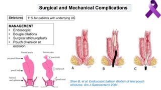 Surgical and Mechanical Complications
Strictures 11% for patients with underlying UC
MANAGEMENT
• Endoscopic
• Bougie dilations
• Surgical stricturoplasty
• Pouch diversion or
excision.
Shen B, et al. Endoscopic balloon dilation of ileal pouch
strictures. Am J Gastroenterol 2004
 