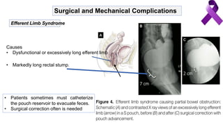 Surgical and Mechanical Complications
Efferent Limb Syndrome
Causes
• Dysfunctional or excessively long efferent limb
• Markedly long rectal stump.
• Patients sometimes must catheterize
the pouch reservoir to evacuate feces.
• Surgical correction often is needed
 
