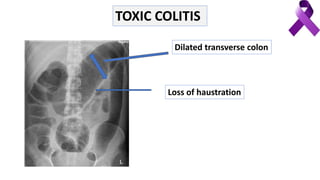 Dilated transverse colon
Loss of haustration
TOXIC COLITIS
 
