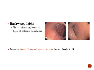  Backwash ileitis:
 More refractory course
 Risk of colonic neoplasia
 Needs small bowel evaluation to exclude CD
 