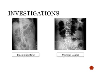 Thumb printing Mucosal island
 
