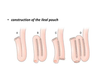 • construction of the ileal pouch
 