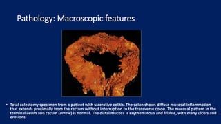 Pathology: Macroscopic features
• Total colectomy specimen from a patient with ulcerative colitis. The colon shows diffuse mucosal inflammation
that extends proximally from the rectum without interruption to the transverse colon. The mucosal pattern in the
terminal ileum and cecum (arrow) is normal. The distal mucosa is erythematous and friable, with many ulcers and
erosions
 