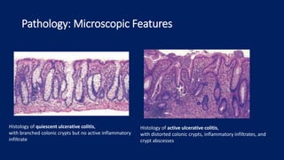 Pathology: Microscopic Features
Histology of quiescent ulcerative colitis,
with branched colonic crypts but no active inflammatory
infiltrate
Histology of active ulcerative colitis,
with distorted colonic crypts, inflammatory infiltrates, and
crypt abscesses
 