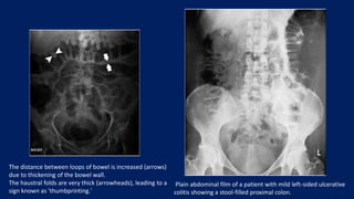 The distance between loops of bowel is increased (arrows)
due to thickening of the bowel wall.
The haustral folds are very thick (arrowheads), leading to a
sign known as 'thumbprinting.'
Plain abdominal film of a patient with mild left-sided ulcerative
colitis showing a stool-filled proximal colon.
 