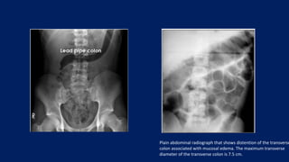 Plain abdominal radiograph that shows distention of the transverse
colon associated with mucosal edema. The maximum transverse
diameter of the transverse colon is 7.5 cm.
 