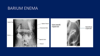BARIUM ENEMA
 