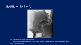 BARIUM ENEMA
Film from a barium enema examination
postinflammatory polyposis in a shortened sigmoid and descending colon in a patient with
active ulcerative colitis.
 