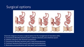 Surgical options
Schematic diagrams of various surgical options for the management of ulcerative colitis.
A, Conventional (Brooke) ileostomy with a subtotal colectomy and a Hartman pouch.
B, Subtotal colectomy with ileorectal anastomosis.
C, Conventional (Brooke) ileostomy with a total proctocolectomy.
D, Continent ileostomy (Koch pouch) with total proctocolectomy.
E, Restorative proctocolectomy with ileal pouch anal anastomosis
 