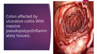 Ulcerative collitis.pptx