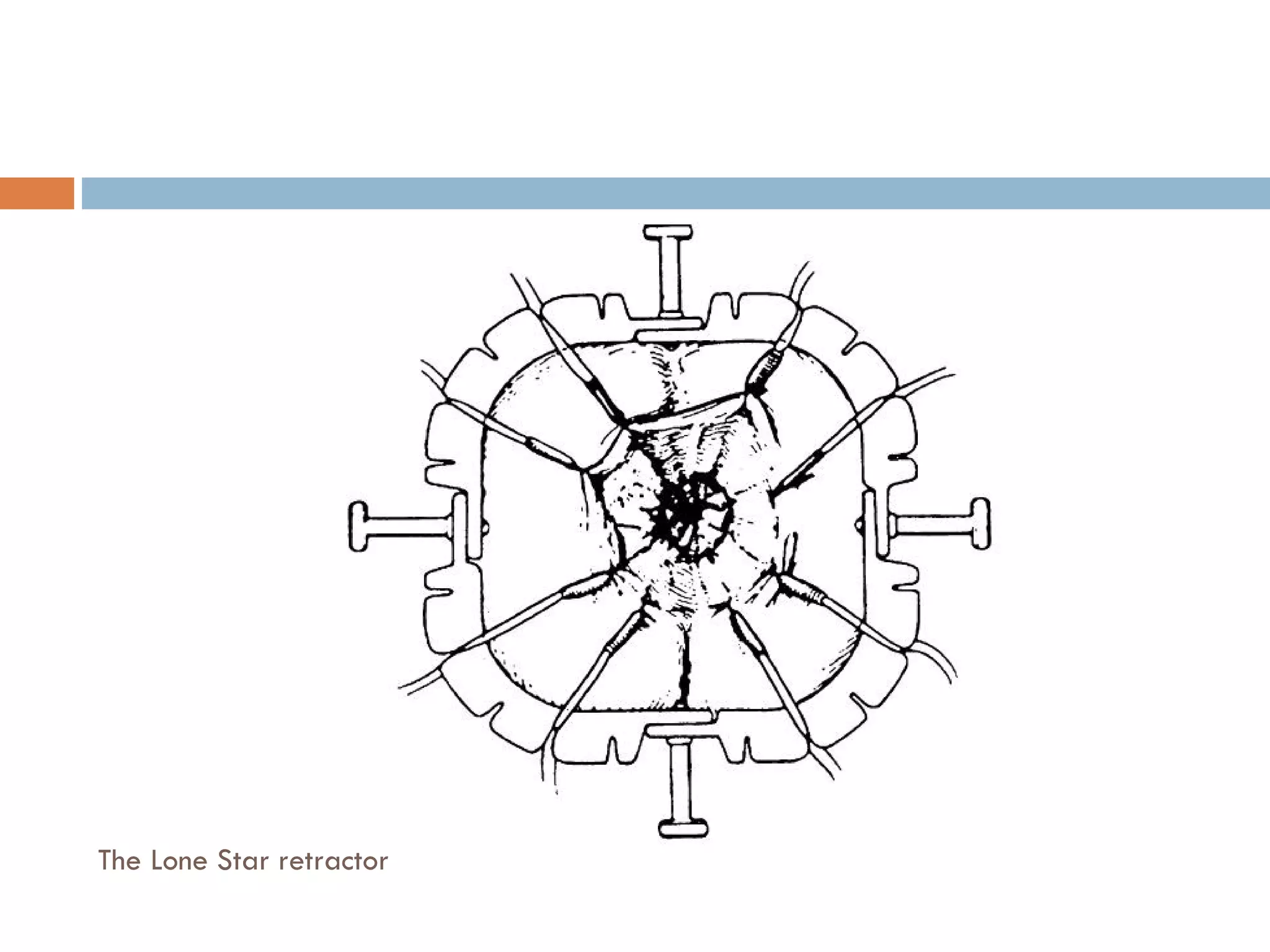 The Lone Star retractor 
