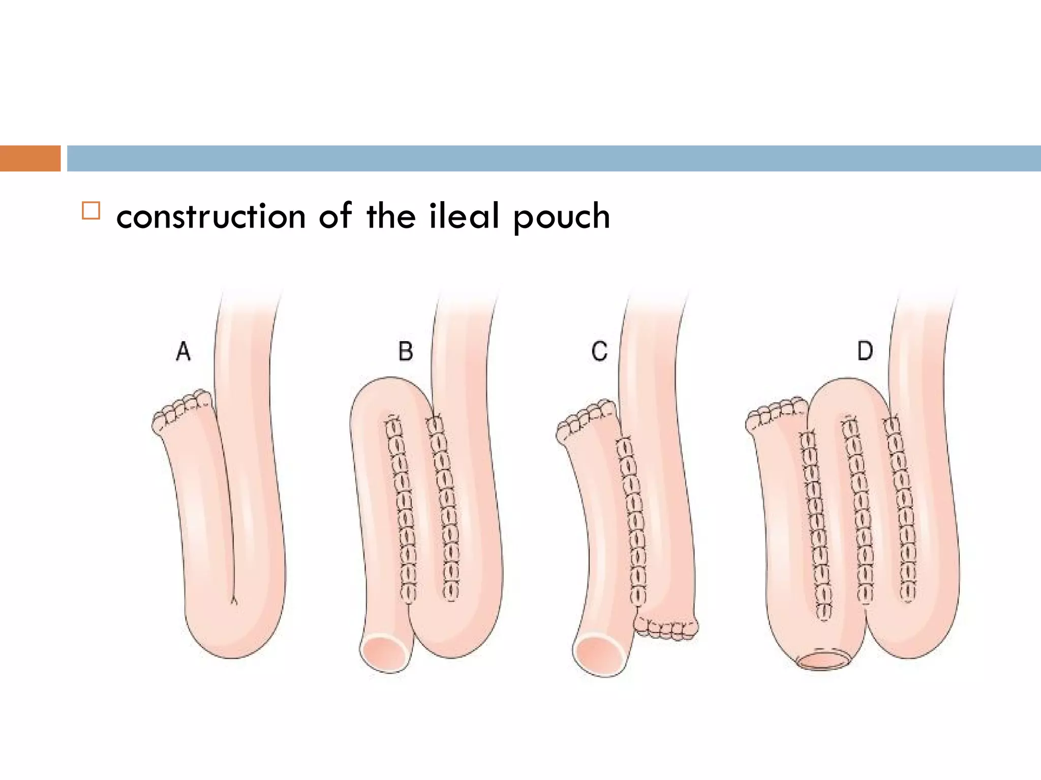 construction of the ileal pouch 