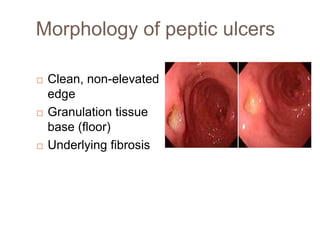 Morphology of peptic ulcers






Clean, non-elevated
edge
Granulation tissue
base (floor)
Underlying fibrosis

 
