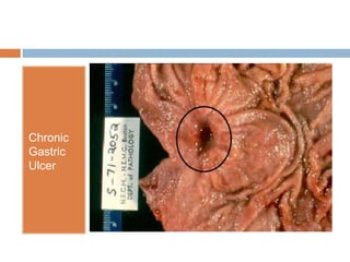 Chronic
Gastric
Ulcer

 