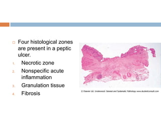 

1.
2.

3.
4.

Four histological zones
are present in a peptic
ulcer.
Necrotic zone
Nonspecific acute
inflammation
Granulation tissue
Fibrosis

 