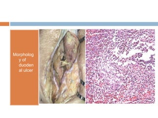 Morpholog
y of
duoden
al ulcer

 