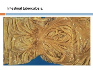 Intestinal tuberculosis.

 