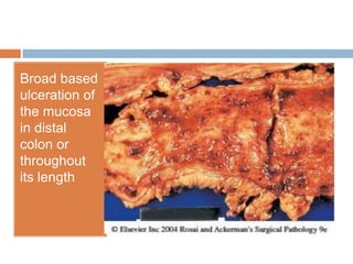 Broad based
ulceration of
the mucosa
in distal
colon or
throughout
its length

 