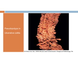 Pseudopolyps in
Ulcerative colitis

 