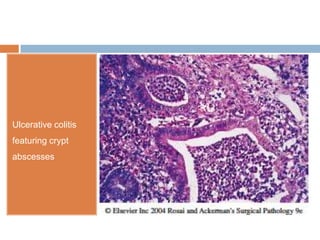 Ulcerative colitis
featuring crypt
abscesses

 