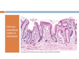 Chronic
ulcerative
colitis in
remission

 