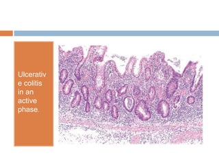 Ulcerativ
e colitis
in an
active
phase.

 