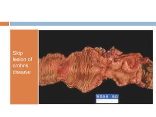 Skip
lesion of
crohns
disease

 