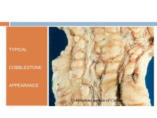 TYPICAL

COBBLESTONE

APPEARANCE

 