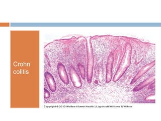 Crohn
colitis

 