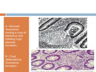A - Mucosal
Granuloma
eroding a crypt of
lieberkhun and
initiating crypt
abscess
formation.

B - Crypt
obliterated by
Granuloma
formation

 